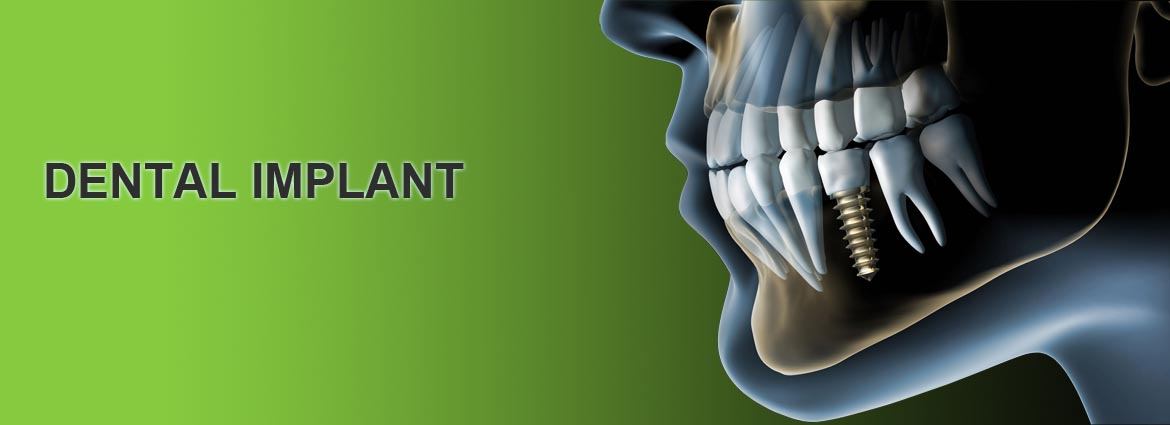 implantaciya zubov v yaroslavle